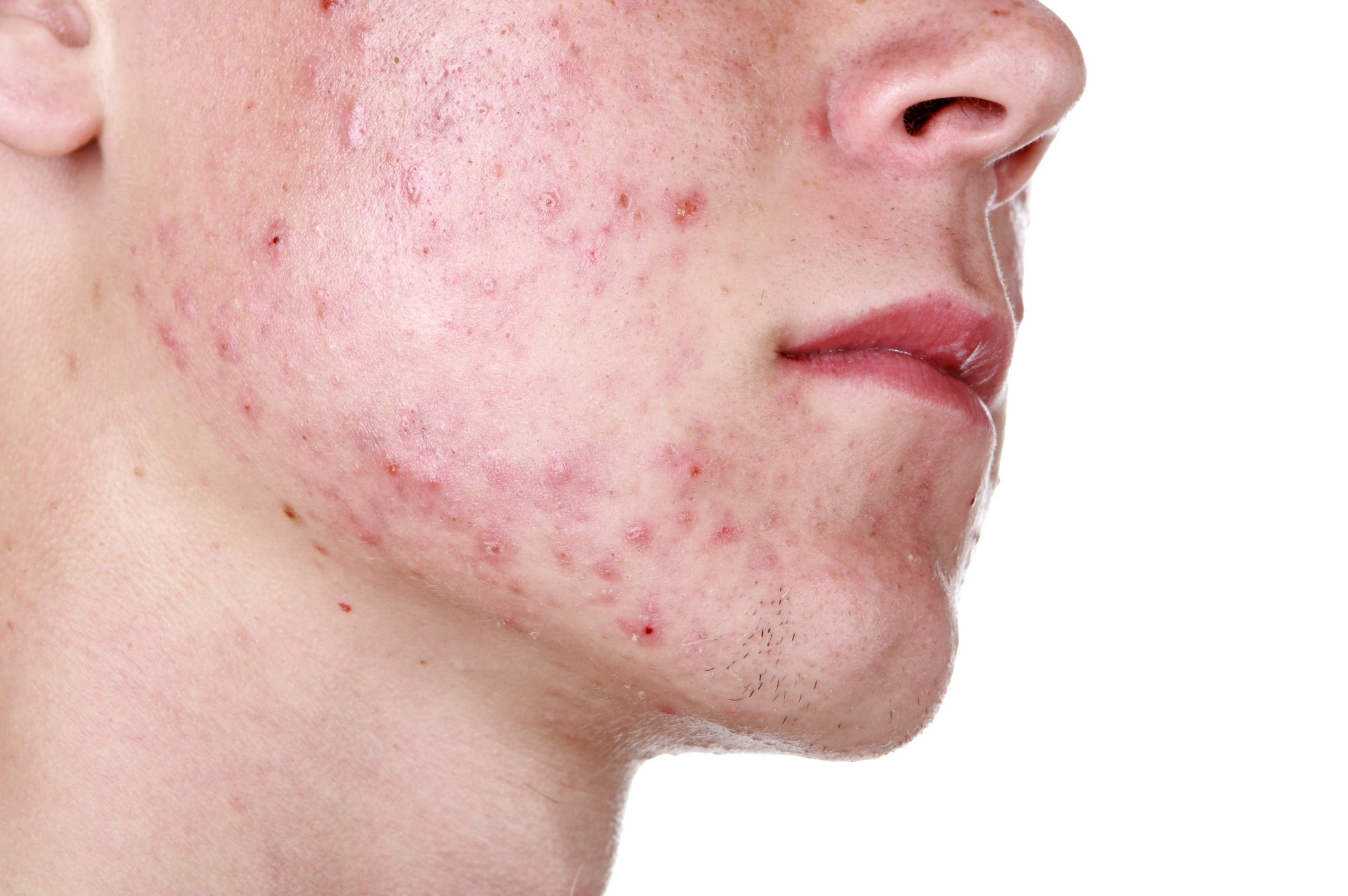 Acne กลุ่มสิว คลิกดูรายการ
